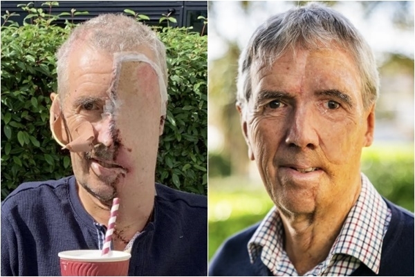 삼차원 인쇄 안면보형물로 삶을 회복한 사례